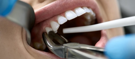 dentist treating on a chipped tooth