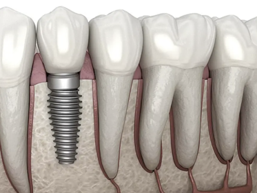 Dental Implants