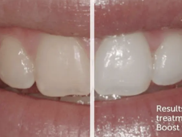 Teeth Whitening