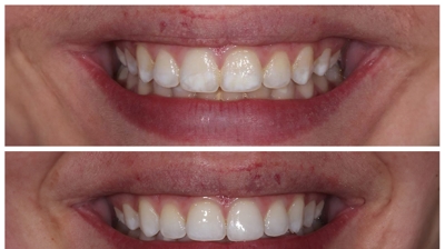 Icon Resin Infiltration – White Spot Removal