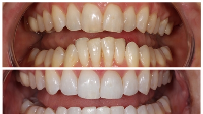 Invisalign