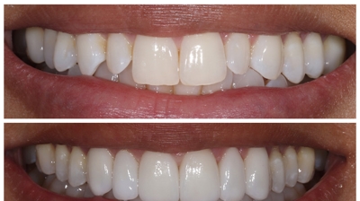 Veneers & Crowns