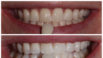 Whitening