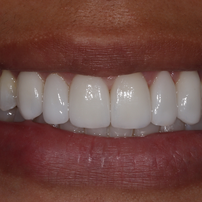 Veneers & Crowns